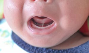 Therapist demonstrating oral exercises for treating tongue tie.